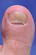 Close up image of foot toe nail suffering from fungus infection