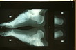 radio, pied, radiologie