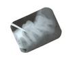 tooth x-ray