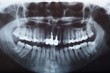 X-ray, rtg of dental detail