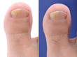 Close up image of foot toe nail suffering from fungus infection