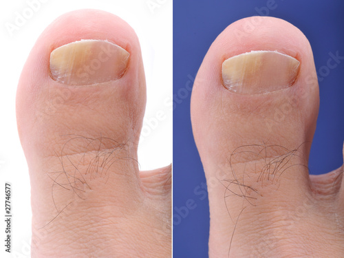 Photo: Close up image of foot toe nail suffering from fungus infection Close up image of foot toe nail suffering from fungus infection