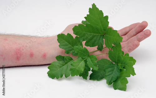 Photo: Poison ivy and human hand with real skin rash. Poison ivy and human hand with real skin rash.