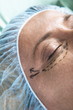 Close up of patient's face with incision lines