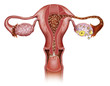 Utero procreacion