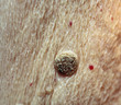 Wart