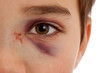 Photo: Gebrochene Nase und verletztes blaues Auge nach Unfall Gebrochene Nase und verletztes blaues Auge nach Unfall
