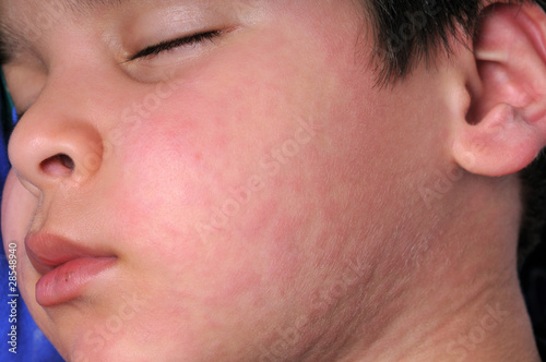 Photo: Little cute boy sleeping in his bed suffering urticaria. Little cute boy sleeping in his bed suffering urticaria.