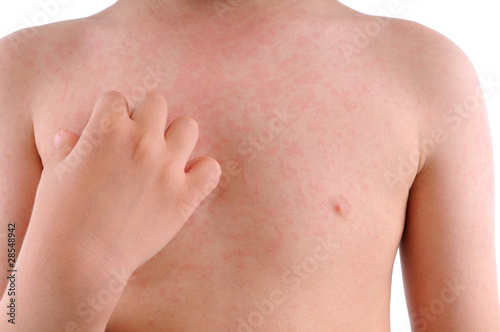Photo: Close up image of a little boy’s body suffering urticaria. Close up image of a little boy’s body suffering urticaria.