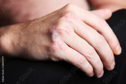 Photo: psoriasis - schuppenflechte an der Hand - nahaufnahme psoriasis - schuppenflechte an der Hand - nahaufnahme