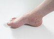 ankle sprain