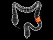 transparenter Darm mit Tumor