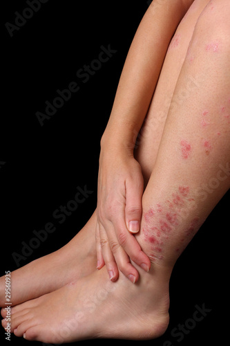 Photo: Psoriasis Psoriasis