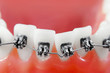 Dental braces super macro ,crooked teeth, shallow depth of field