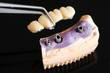 Dental implant head and bridge