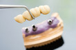 Dental implant head and bridge