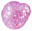 Microscope picture of a bowel tumor