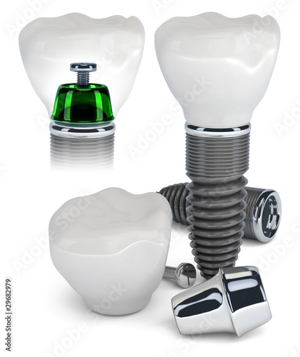 Illustration: Dental Implant construction Dental Implant construction