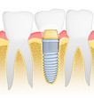 Illustration: Dental Implant Dental Implant
