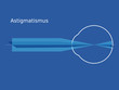 Schema Astigmatismus