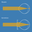 Schema Myopie mit Korrektion