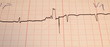 Electrocardiogram ecg