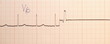 Electrocardiogram ECG,EKG