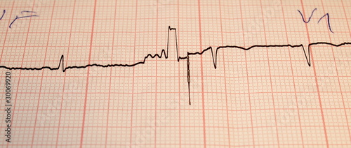 Photo: Electrocardiogram ecg Electrocardiogram ecg