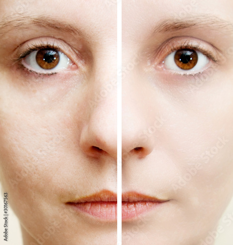 Photo: Woman with spotty skin with deep pores and healed soft skin Woman with spotty skin with deep pores and healed soft skin