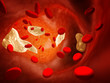 Atherosclerosis