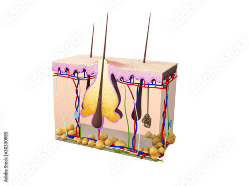 Illustration: Querschnitt Haut - Akne Illustration Querschnitt Haut - Akne Illustration