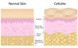 Cellulite versus smooth skin, eps8