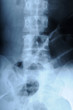 radiograph of human backbone