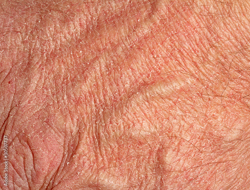 Photo: Dry skin on hand Dry skin on hand