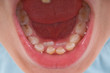 New teeth of a child coming to replace the old ones.
