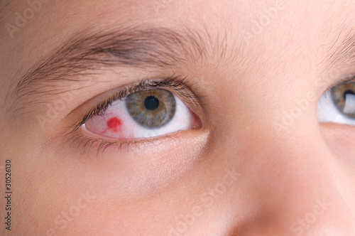 Photo: High resolution macro photo of an infected eye of a child. High resolution macro photo of an infected eye of a child.