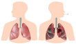 Smoker's lung (with tumor) vs healthy lung, eps8