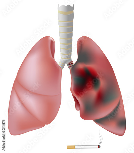 smoking lungs vs healthy lungs. versus healthy lung, eps8