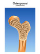 Osteoporosi