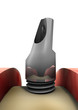 CadCam Implantologie