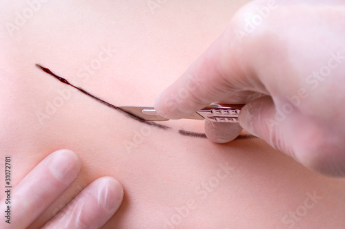Photo: Scalpel cut Scalpel cut