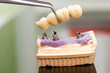Dental implant head and bridge