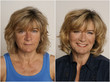 Vorher-Nachher-Bild einer Frau