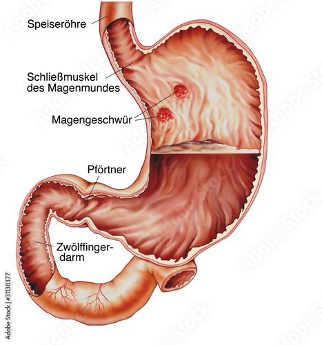 Illustration: Magen im Querschnitt.Magengeschwuer Magen im Querschnitt.Magengeschwuer