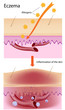 Eczema, eps8