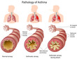 Anatomy of Asthma, eps8