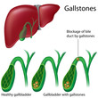 Gallstones, eps8