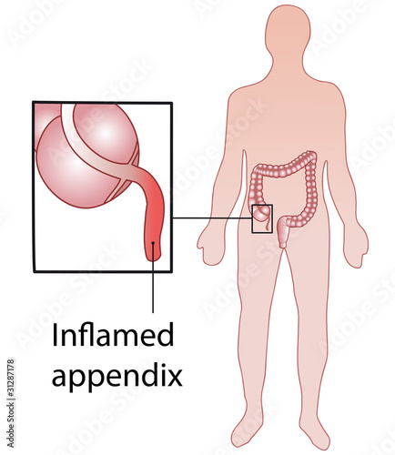 Vector: Inflamed appendix Inflamed appendix