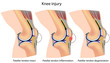 Jumper's knee anatomy, eps8