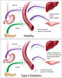 Type 2 diabetes, eps8